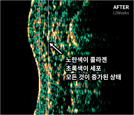 V&MJ After 노란색이 콜라겐 초록색이 세포 모든 것이 증가된 상태