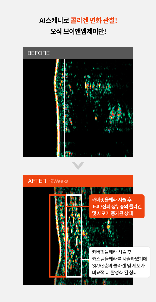 AI스케나로 콜라겐 변화 관찰! 오직 브이엔앰제이만!