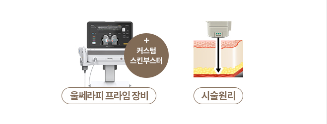 울쎄라피 프라임 장비, 시술 원리