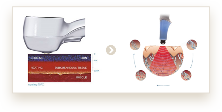 리프팅레이저,강남리프팅,눈가주름,리프팅성형외과,강남인모드,리프팅가격,매선리프팅,주름리프팅,리프팅종류,리프팅병원,팔자리프팅,주름제거,팔자주름리프팅,풀페이스리프팅